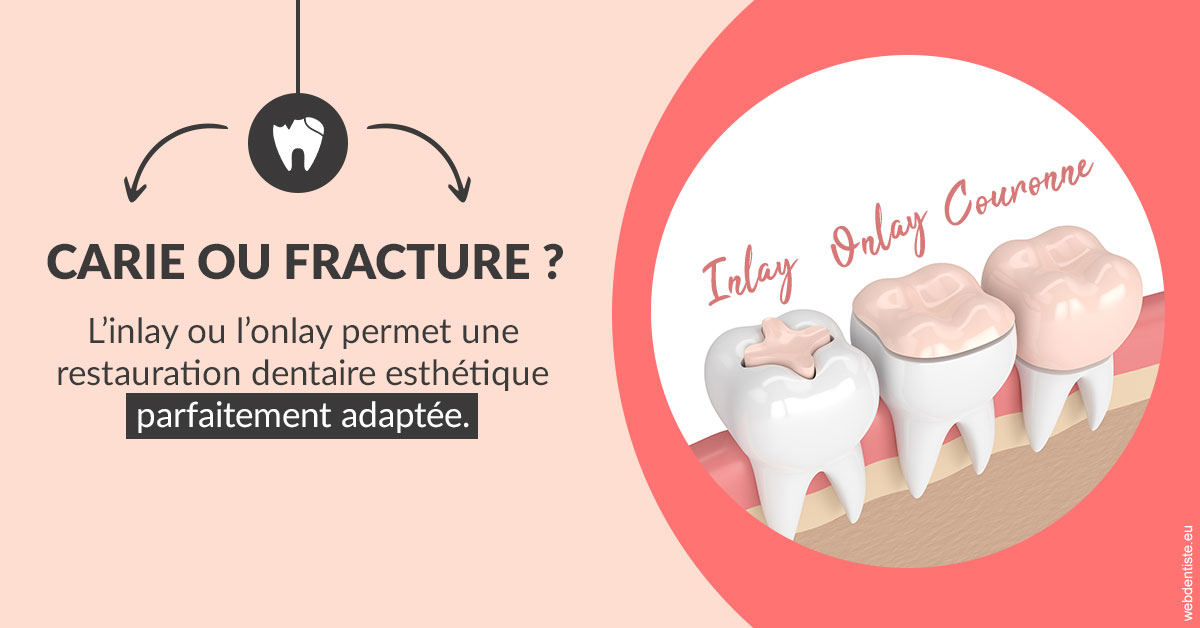 https://www.clinique-dentaire-lugari-garlaban.fr/T2 2023 - Carie ou fracture 2