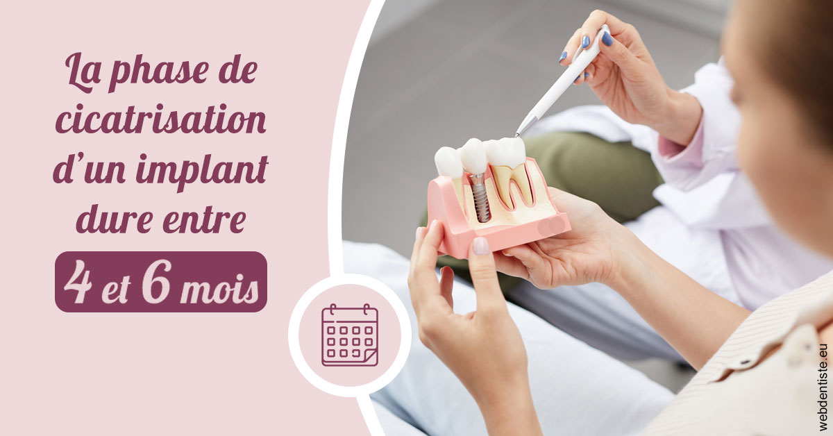 https://www.clinique-dentaire-lugari-garlaban.fr/Cicatrisation implant 2