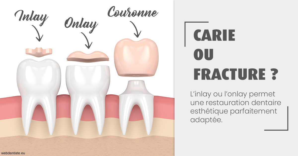 https://www.clinique-dentaire-lugari-garlaban.fr/T2 2023 - Carie ou fracture 1