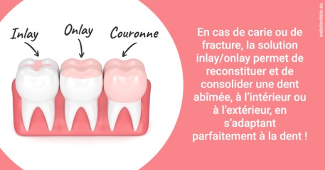 https://www.clinique-dentaire-lugari-garlaban.fr/L'INLAY ou l'ONLAY 2