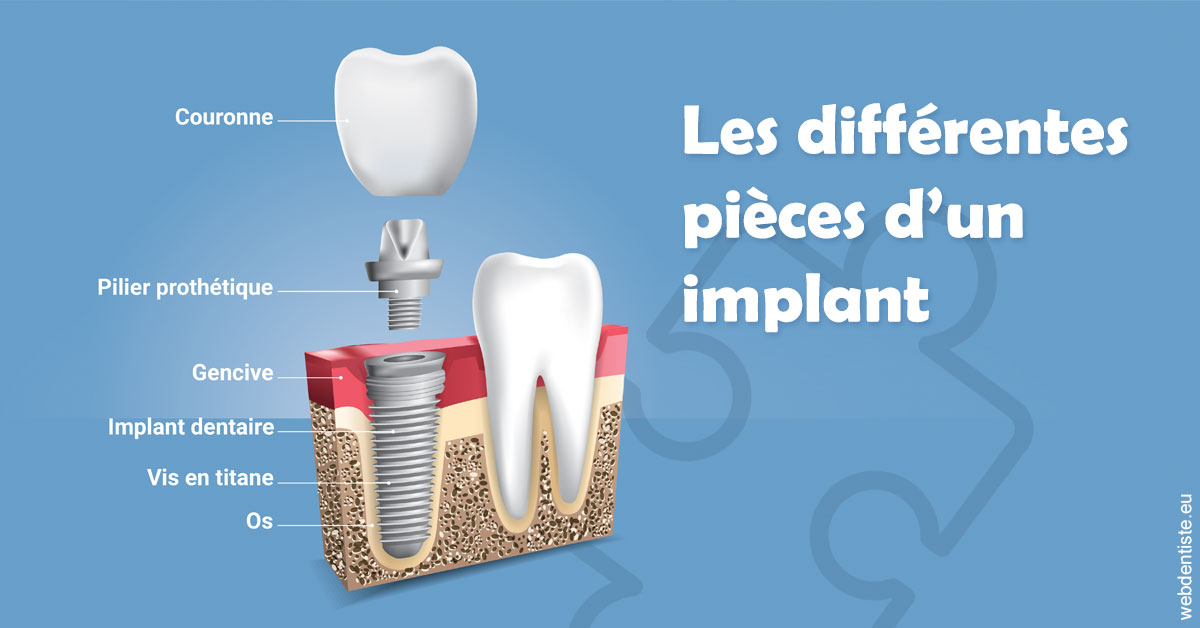 https://www.clinique-dentaire-lugari-garlaban.fr/Les différentes pièces d’un implant 1